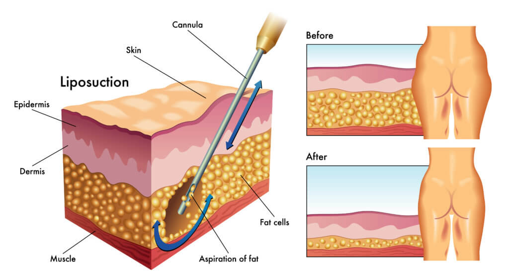 Reviewing the Different Types of Laser Liposuction